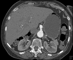 Celiac Artery Aneurysm - CTisus CT Scan