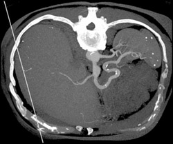 Celiac Artery Aneurysm - CTisus CT Scan
