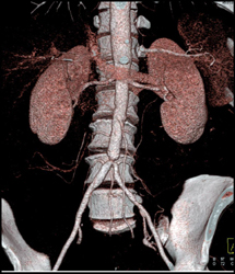 Stenosis at Aortoiliac Bifurcation Due to Vasculitis - CTisus CT Scan