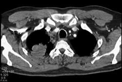 Lung Cancer With SVC Syndrome - CTisus CT Scan