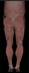 Diseased Left Superficial Femoral Artery (SFA) - CTisus CT Scan