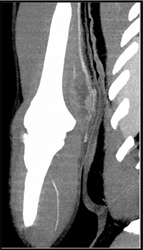 Cellulitis With Focal Abscess - CTisus CT Scan