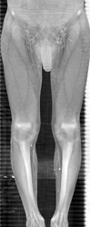 Normal Superficial Femoral Arteries (SFAs) - CTisus CT Scan
