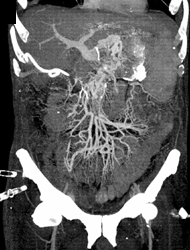 Engorged Mesenteric Vessels - CTisus CT Scan