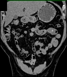 Bleeding Arteriovenous Malformation (AVM) in the Proximal Small Bowel - CTisus CT Scan