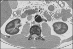 Aortic Dissection - CTisus CT Scan