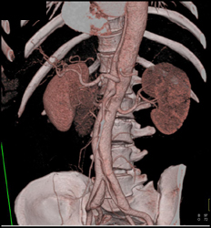 Aortic Dissection - CTisus CT Scan