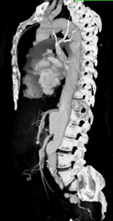 Pseudo Aneurysm at Level Celiac Aa - CTisus CT Scan