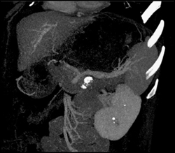 Splenic Aa Aneurysm Simulates A Pancreatic Mass - CTisus CT Scan