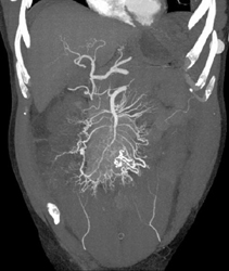 Carcinoid With Desmoplastic Reaction - CTisus CT Scan