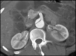 Type B Dissection - CTisus CT Scan