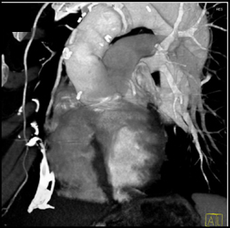 Aortic Root Replacement With Bypass Graft - CTisus CT Scan
