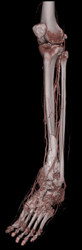 Normal Runoff S/P Trauma - CTisus CT Scan