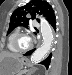 Endovascular Stent - CTisus CT Scan