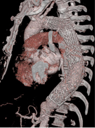 Endovascular Stent - CTisus CT Scan