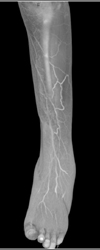Runoff With Peripheral Vascular Disease (PVD) - CTisus CT Scan