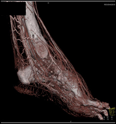 Run Off Study in Diabetic - CTisus CT Scan
