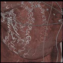 Abdominal Wall Collateral Due to IVC Occlusion - CTisus CT Scan