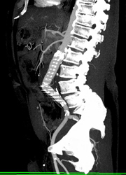 Stent in Aortic W/o Endoleak - CTisus CT Scan