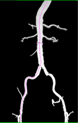 Center Line Measurement Software - CTisus CT Scan