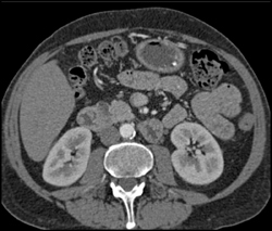 Normal SMA Angle - CTisus CT Scan