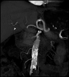 Plaque in Splenic Artery - CTisus CT Scan