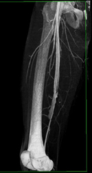 Arteriovenous (AV) Fistulae Due to GSW - CTisus CT Scan