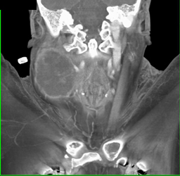 Necrotic Tumor in Right Neck Occludes Jugular Vein - CTisus CT Scan