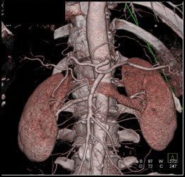 Normal Mesenteric Artery - CTisus CT Scan