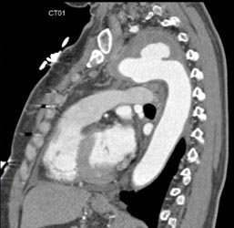 Ulcer With Aneurysm - CTisus CT Scan