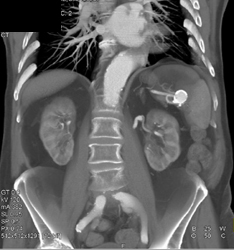Splenic Artery Aneurysm - CTisus CT Scan