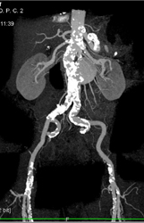 Renal Artery Aneurysm - CTisus CT Scan