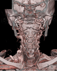 Ectatic Carotid Arteries in Loeys-Dietz - CTisus CT Scan