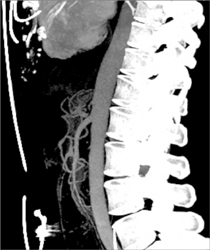 Median Arcuate Ligament Syndrome - CTisus CT Scan