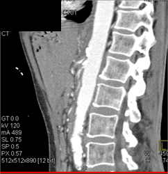 Median Arcuate Ligament Syndrome - CTisus CT Scan