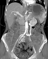 Bypass Grafts to Mesenteric Circulation-iliac Artery to SMA - CTisus CT Scan