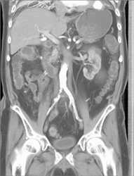 Right Common Iliac Artery Stenosis - CTisus CT Scan