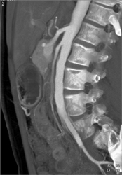Superior Mesenteric Artery (SMA) Stenosis - CTisus CT Scan