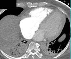 Pulmonary Embolism - CTisus CT Scan