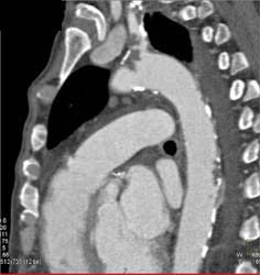 Thrombus in Aortic Arch - CTisus CT Scan