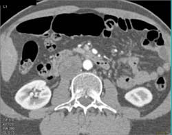 Neurogenic Tumor Pushes on IVC - CTisus CT Scan