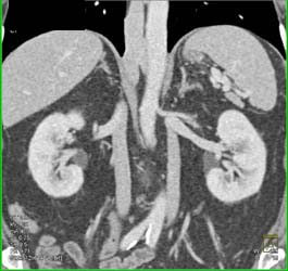 Duplicated Inferior Vena Cava (IVC) - CTisus CT Scan