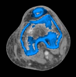 3D With Bone Editing for Normal Trifurcation Vessels - CTisus CT Scan