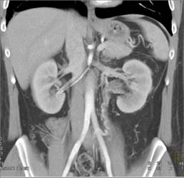 Chronic Left Renal Vein Thrombosis With Collaterals - CTisus CT Scan