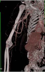 Av Shunt for Dialysis - CTisus CT Scan