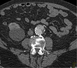 Endoleak - CTisus CT Scan