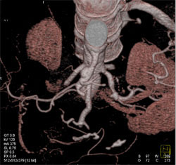 Celiac Artery Aneurysm - CTisus CT Scan