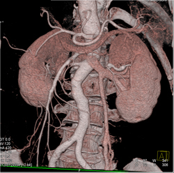 Normal Renal and Gonadal Vein - CTisus CT Scan