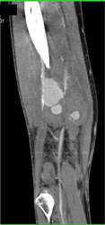 Pseudo Aneurysm S/P Trauma - CTisus CT Scan