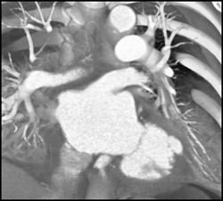 Lv Aneurysm Or Diverticulum - CTisus CT Scan